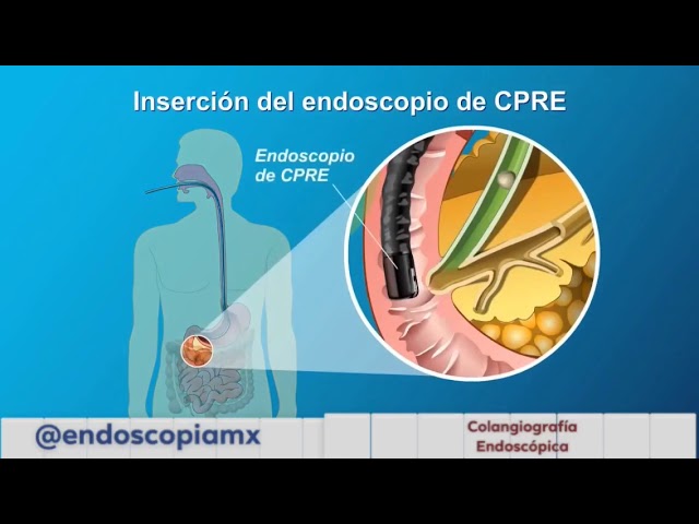identificación de obstrucciones internas